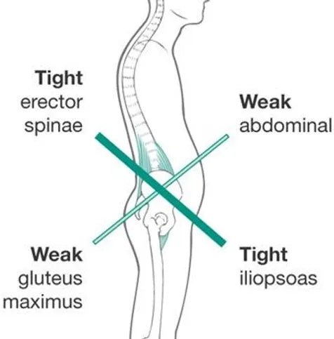 Anterior Pelvic Tilt Routine - Posturehealing
